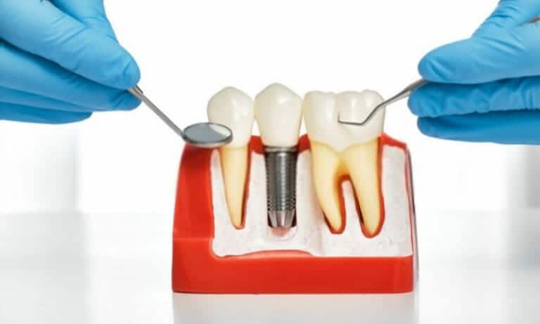 Three Main Stages Of All-on-Four Dental Implant Procedure