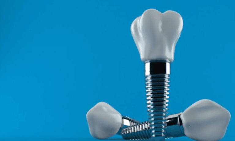 How Are Dental Implants Beneficial For Your Oral Health?