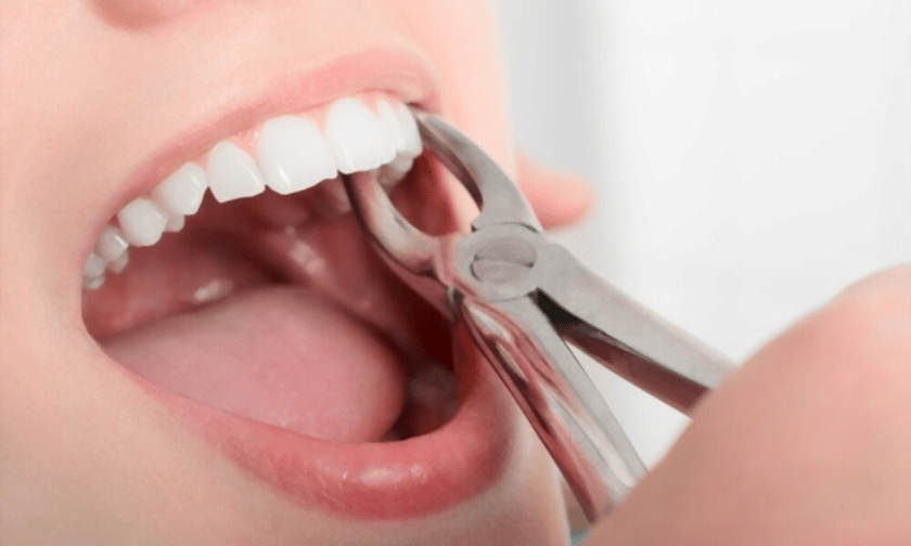 Unknown Facts About Wisdom Tooth Removal