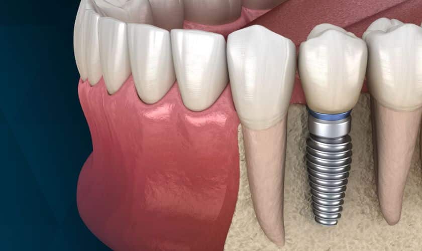 How Long Does it Take for Dental Bone Graft to Heal?