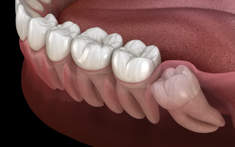 Wisdom Teeth Extraction - Beverly Hills Oral