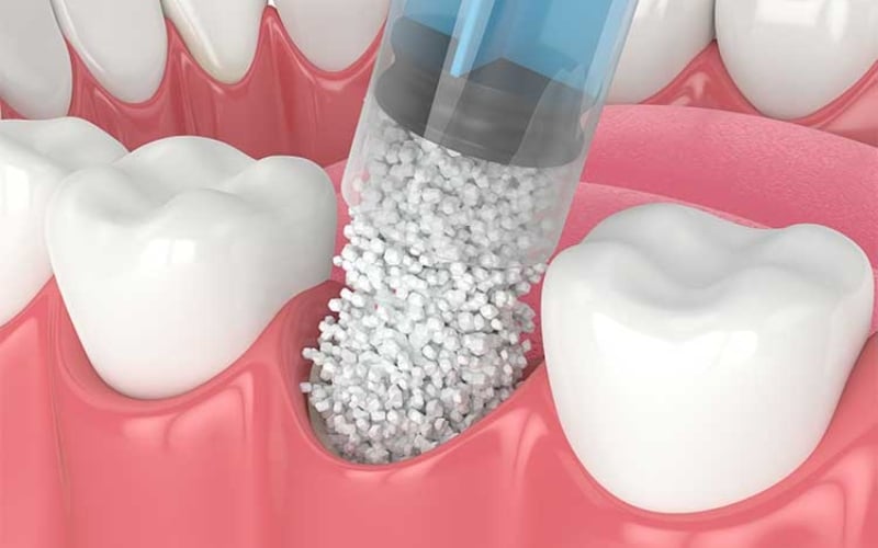 Is Bone Grafting Necessary For Implants?