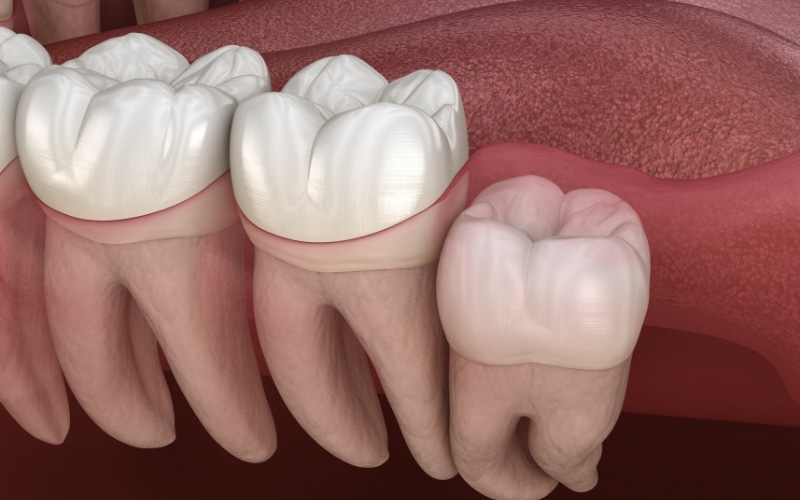 Wisdom Tooth Extraction - Beverly Hills Oral