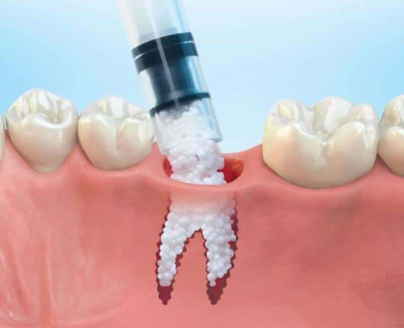 Why Is Bone Grafting So Expensive? Oral Surgeon Beverly Hills