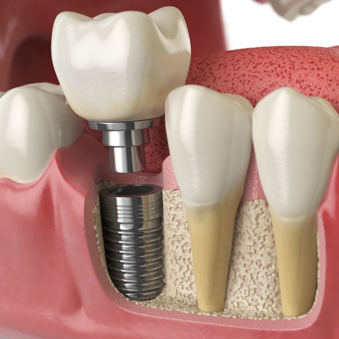 dental implants beverly hills