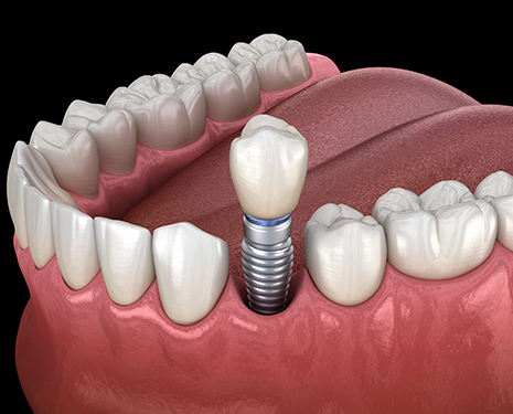 single dental implants beverly hills