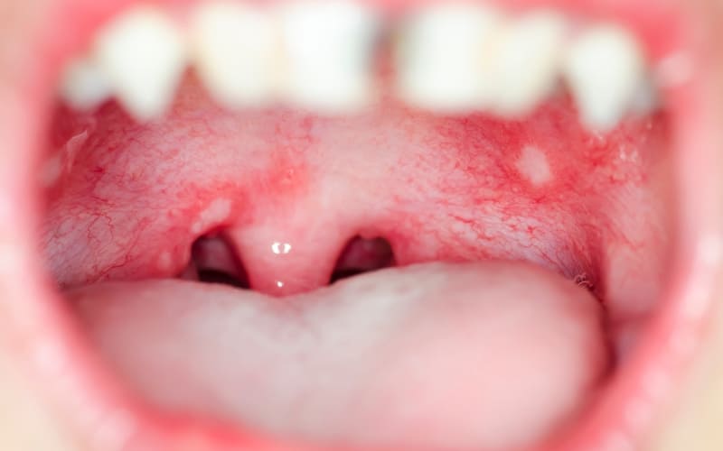 What Are The Signs Of Infection In Your Mouth