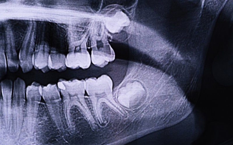 wisdom teeth grow back after extraction