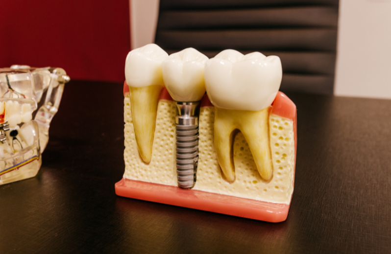 Are Dental Implants Right For You? Key Factors To Consider